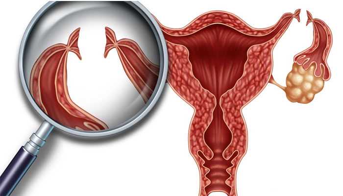 哪些输卵管问题会导致不能自然受孕？